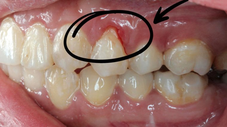 Gum Recession Explained: Causes, Treatments & Prevention
