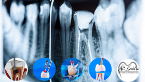 Post-root canal healing tips and expectations.