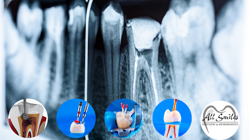 Post-root canal healing tips and expectations.