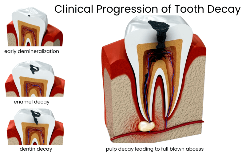clinical-progression-of-tooth-decay