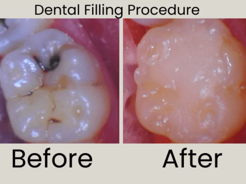 dental filling procedure before after