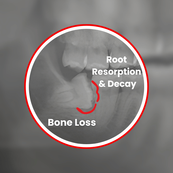 root-resorption-and-decay