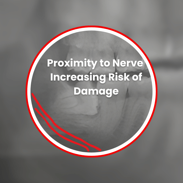 Risks Associated with horizontally impacte wisdom teeth