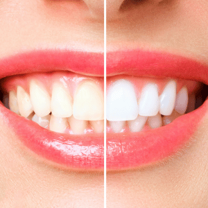 Teeth Whitening before and afters