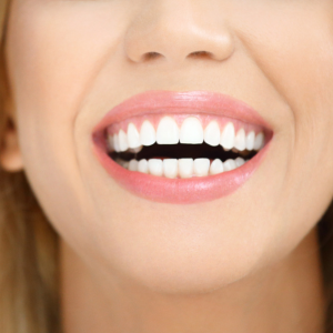 beautiful smile with Veneers
