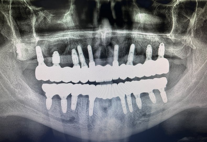Traditional-Dentures