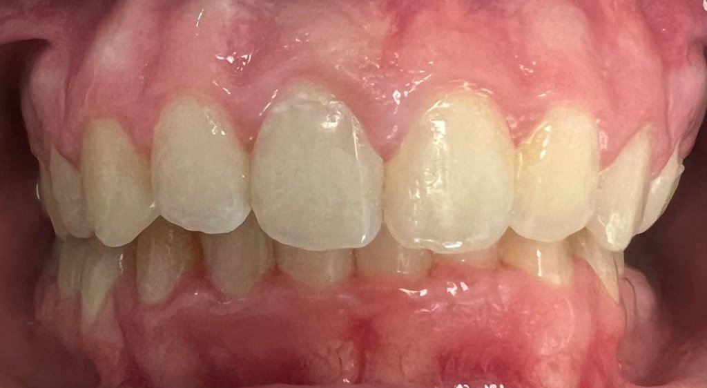 jaw after fastbraces