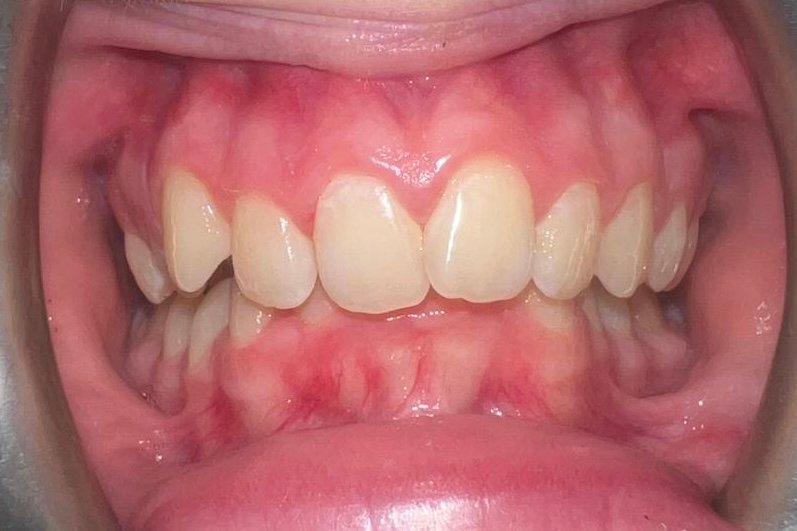 jaw before fastbraces