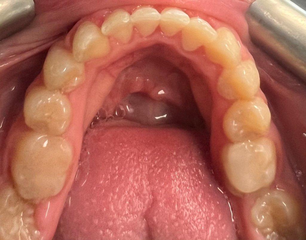 lower jaw after fastbraces
