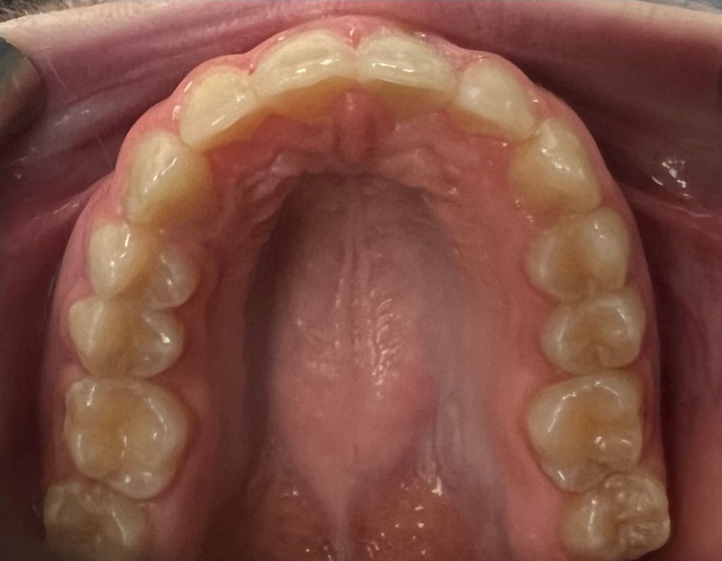 upper jaw After fastbraces