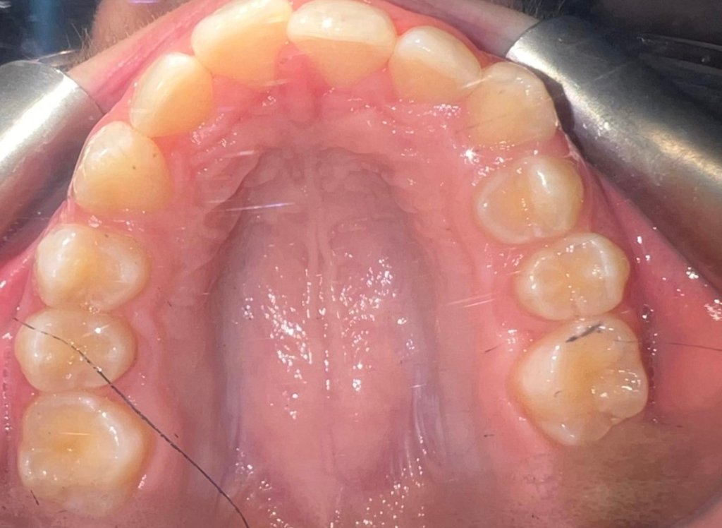 upper jaw before fastbraces