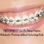 fastbraces treatment