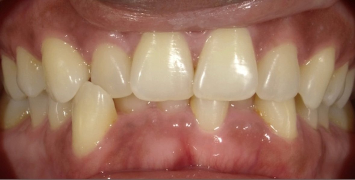 teeth crowding before dental braces