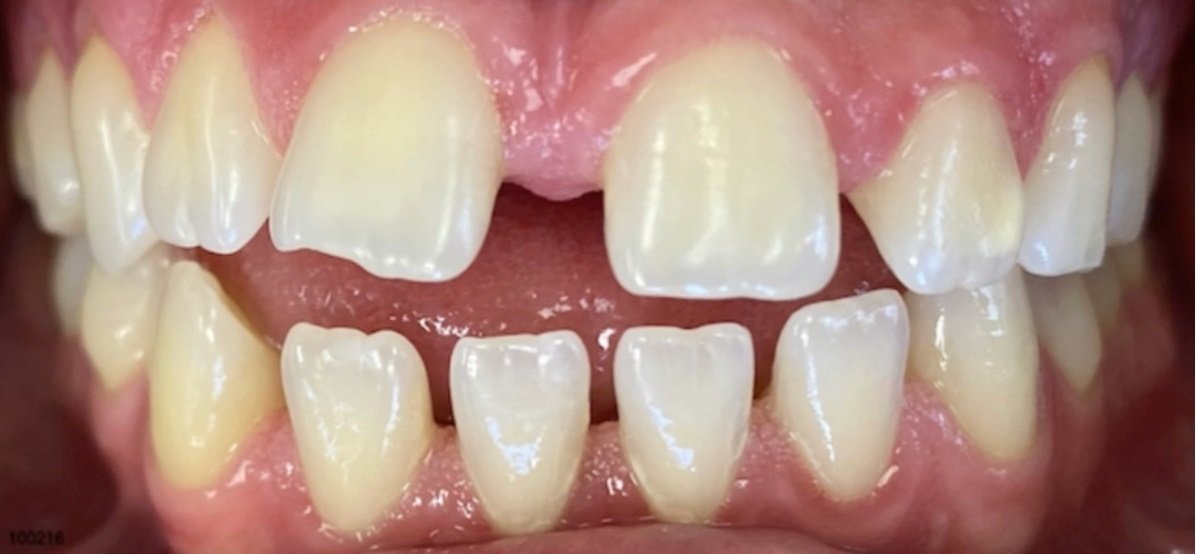 fastbraces spacing before