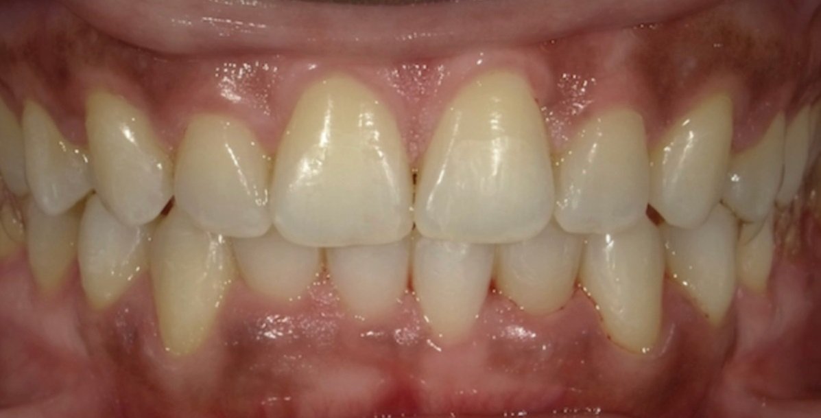 teeth crowding after fastbraces
