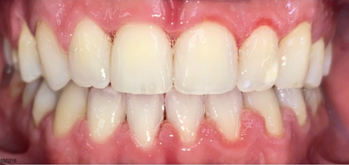 teeth spacing after fastbraces