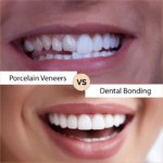 dental veneers vs dental bonding