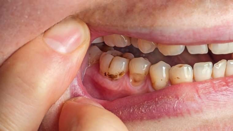 Pulpotomy vs. Pulpectomy