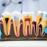 How-Root-Canals-Save-Natural-Teeth-and-Prevent-Bigger-Dental-Problems
