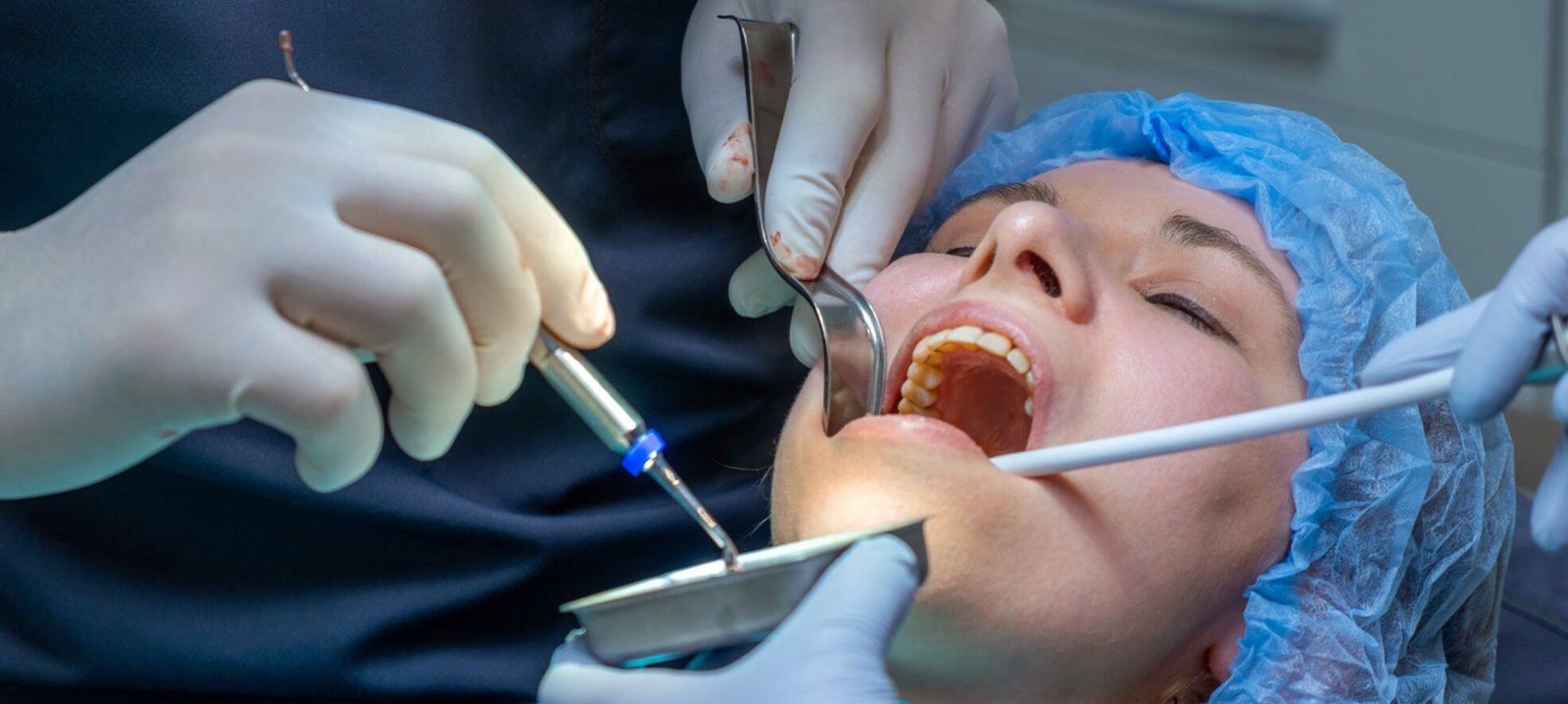 Dental Bone Graft