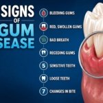 7 Signs of Gum Disease