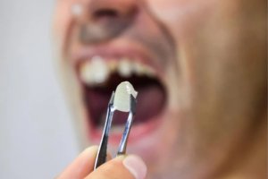 dental-crown-fell-out