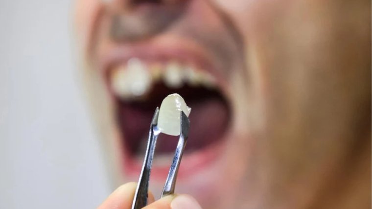 Dental Crown Fell Out, But Doesn’t Hurt: Should I Still See a Dentist?