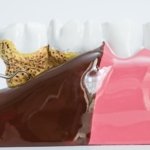 What-Is-Periodontal-Disease