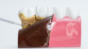 What-Is-Periodontal-Disease
