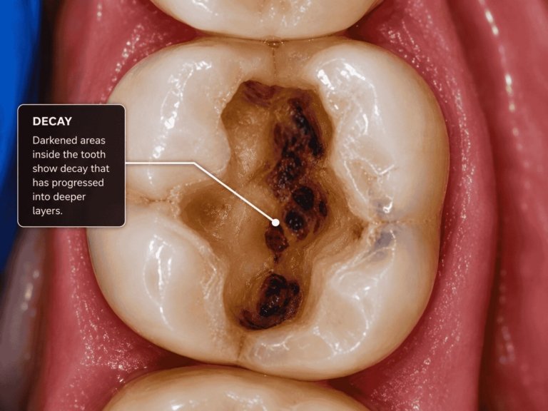 Decay under an old silver amalgam filling uncovered