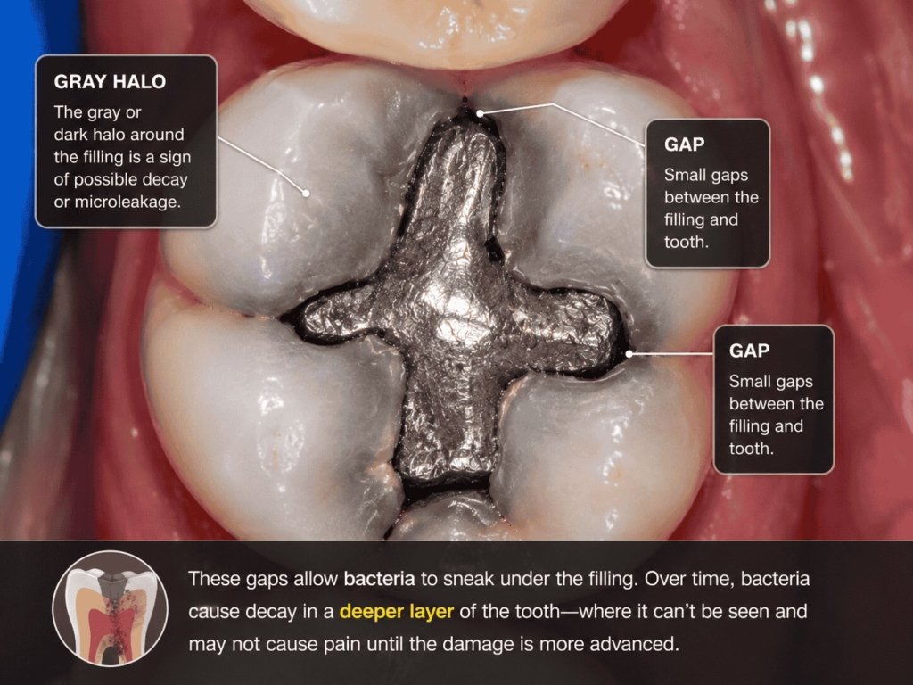 Close-up of an old silver dental filling showing gaps and a gray halo around the filling, indicating possible decay and microleakage
