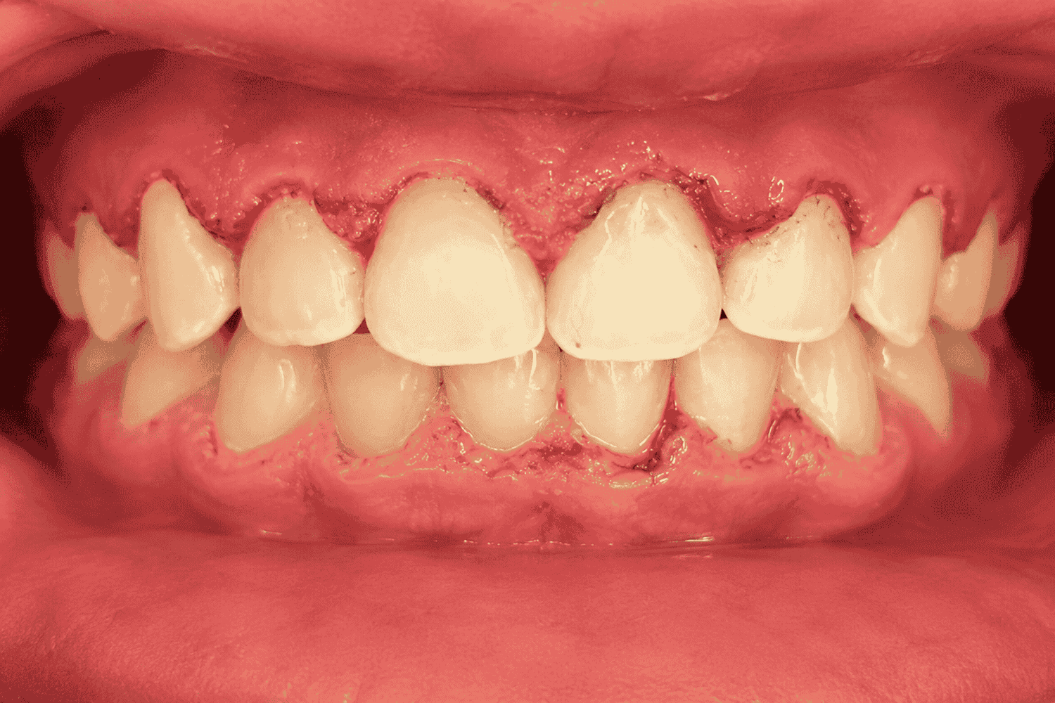 After Gingivectomy
