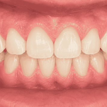 Gum Contouring / Aesthetic Gingivectomy