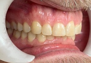 Straightened teeth after orthodontic treatment.