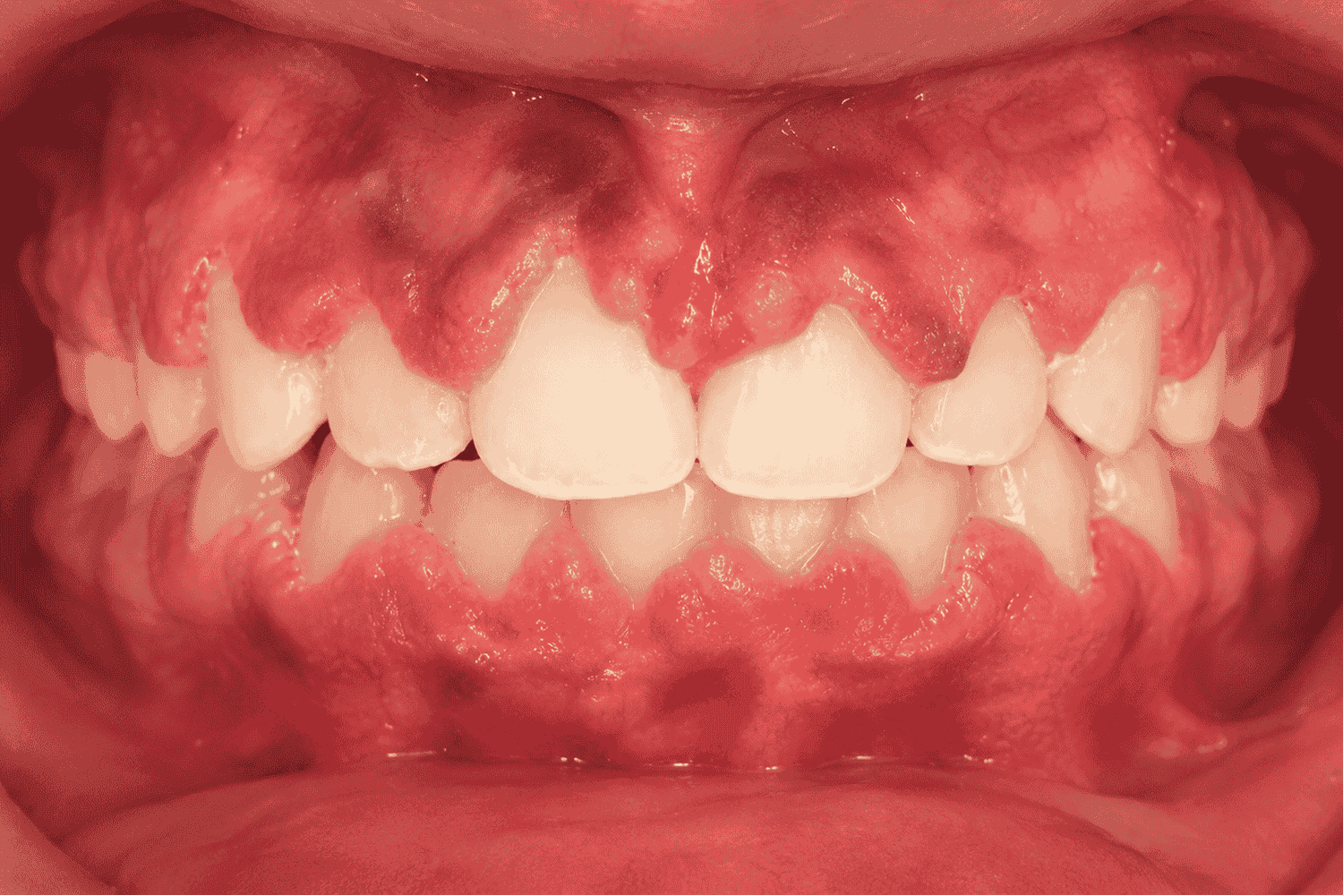 Before Gingivectomy