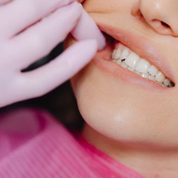 Dental Bonding
