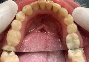Straightened lower arch after orthodontic treatment.