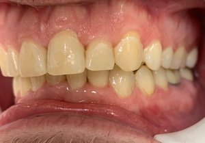 Straightened teeth after orthodontic treatment.