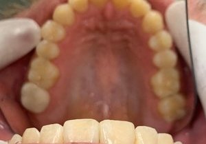 Aligned upper arch after orthodontic treatment.